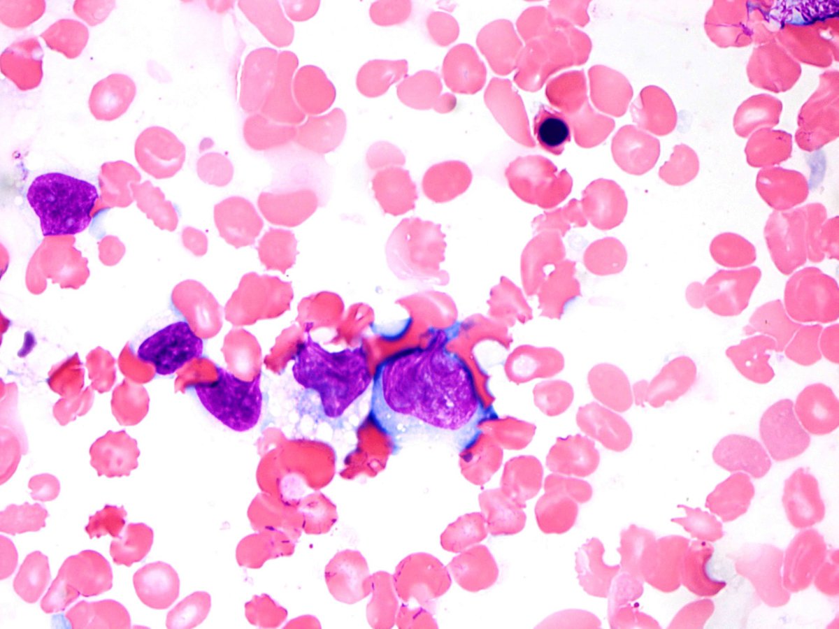 Touch preparation showing atypical large granular lymphoid cell (Wright Giemsa, 1000x)